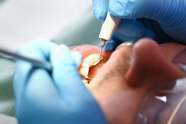 Best Emergency Dental Care for Broken or Chipped Teeth in Jeffersontown, KY